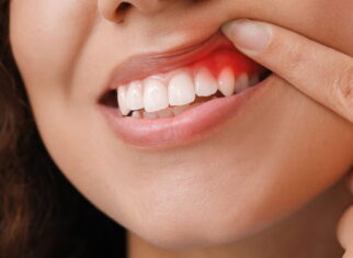 Gingival Recession