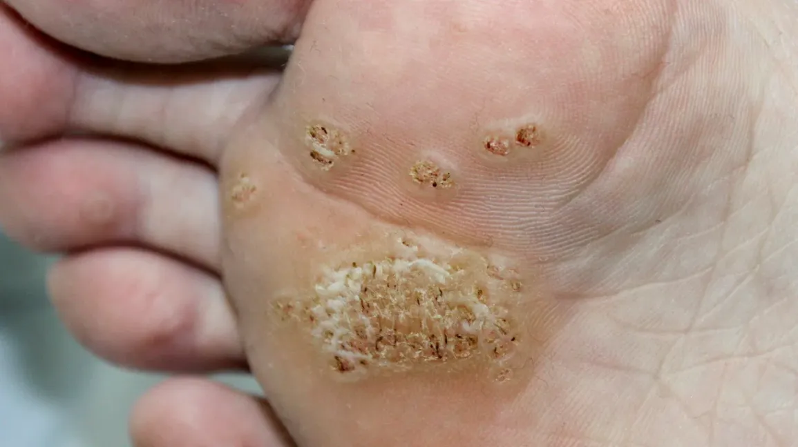 Understanding Warts (疣) and How they Occur