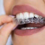 Why Gentle Dentistry Matters for Anxious Children