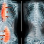 Throat Cancer: Symptoms, Diagnosis and Treatment