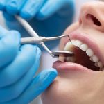 Understanding the Average Cost of Invisalign in Modern Dentistry