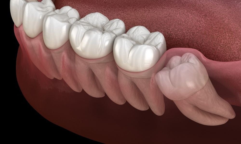 The Pericoronitis Path: How Impacted Wisdom Teeth Create Bacterial Reservoirs and Bleeding Gums