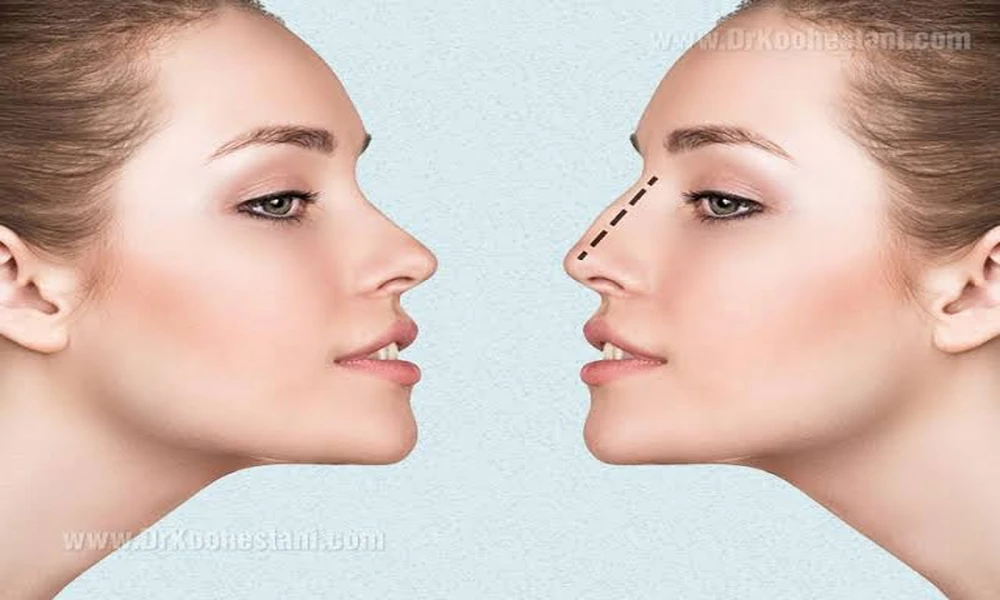 What Makes Beverly Hills and Los Angeles Leading Destinations for Rhinoplasty