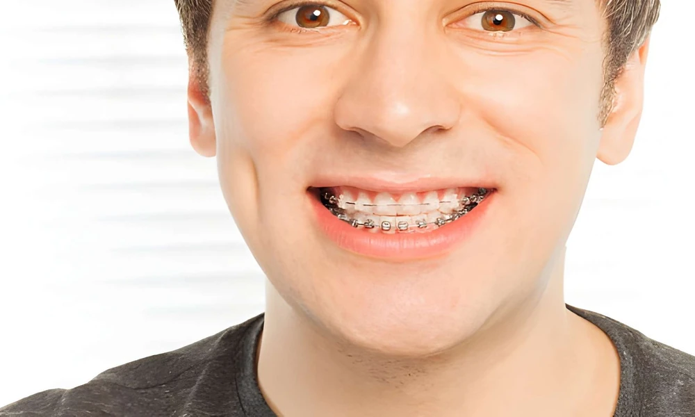 Are Damon Clear Braces Worth the Investment?
