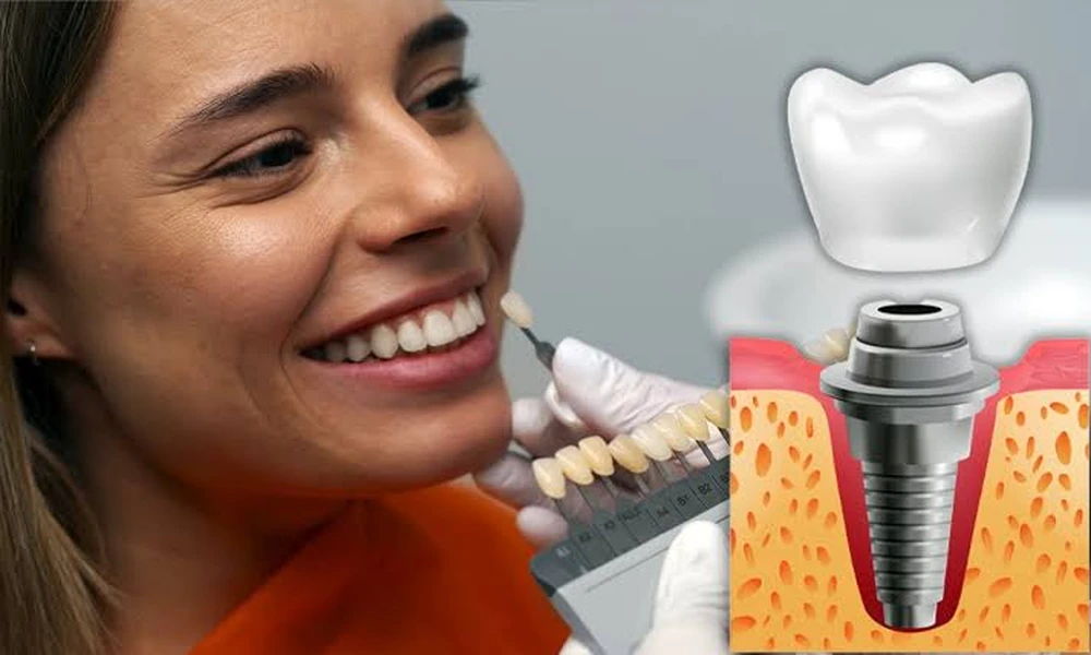 All-on-4 Dental Implants Price in Antalya, Turkey