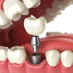 Are Damon Clear Braces Worth the Investment?