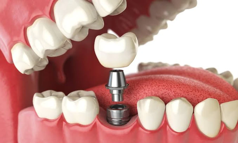 7 Reasons Denture Wearers Switch to Implant-Supported Teeth: Insights From Stubbs Dental and Other Utah Providers